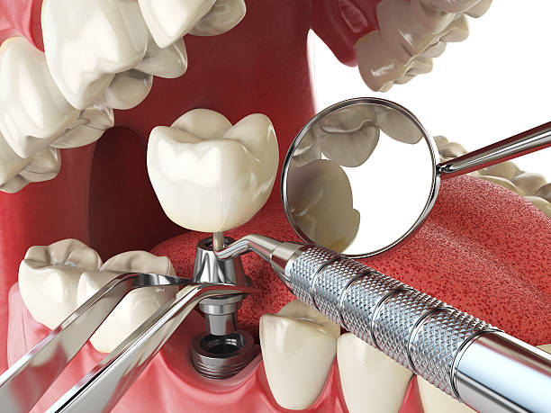 Best Emergency Dental Care for Broken or Chipped Teeth in Choudrant, LA