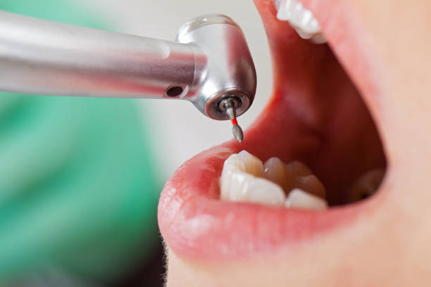 Best Emergency Tooth Extraction in Choudrant, LA